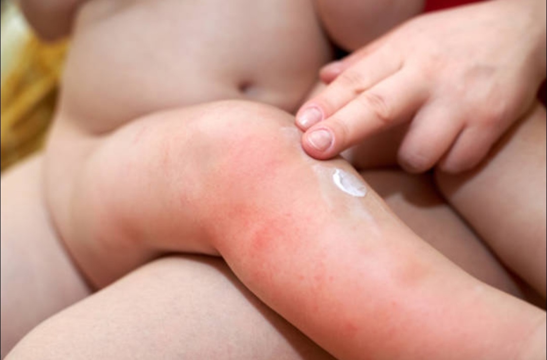 Se lanzó la Primera Campaña de Prevención de Quemaduras Infantiles